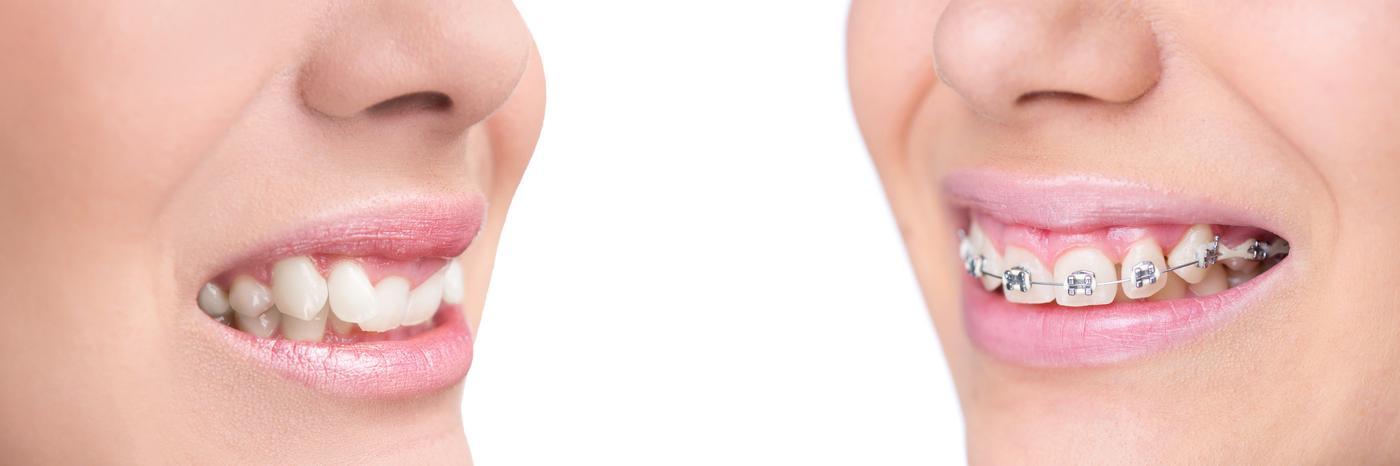 Braces for kids & Adults and Lingual Braces